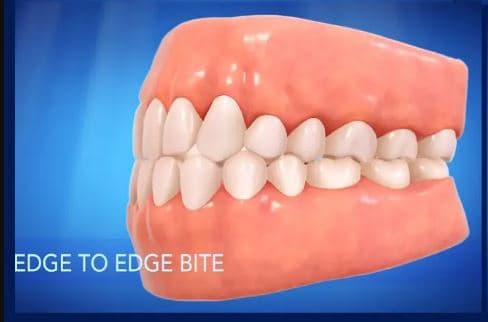Comparison of an edge-to-edge bite versus a typical overlapping bite
