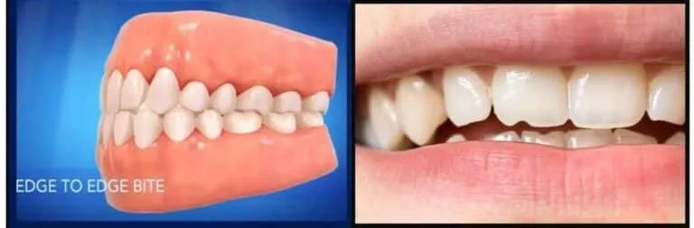 Illustration showing an edge-to-edge bite alongside a chipped tooth