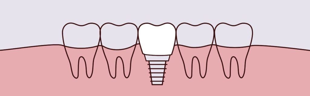 Illustration of a dental implant placed among healthy teeth